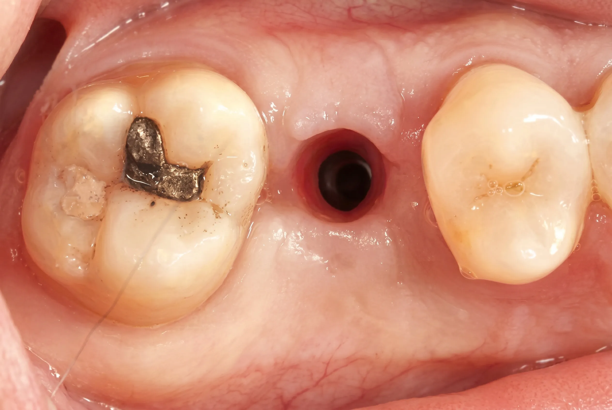 Dental Implant - Before